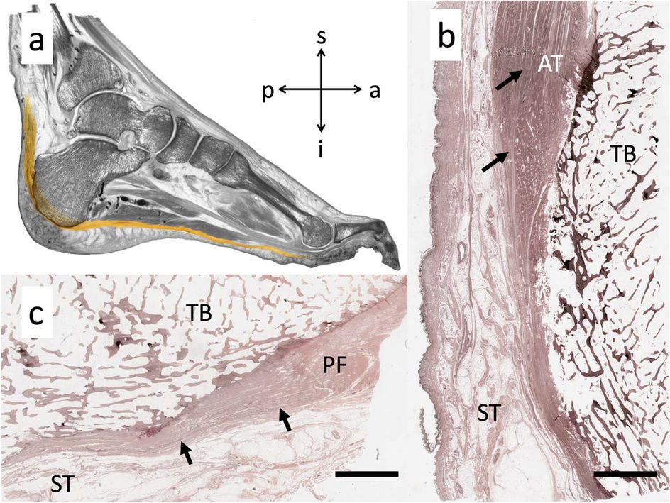 Рис. 3. Сагиттальный срез пяточной кости: трабекулярная архитектура и зона начала подошвенной фасции