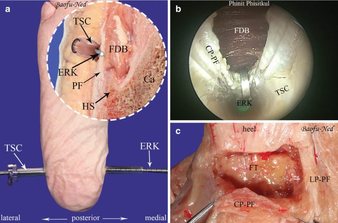 Рис. 10. Эндоскопический релиз подошвенного апоневроза