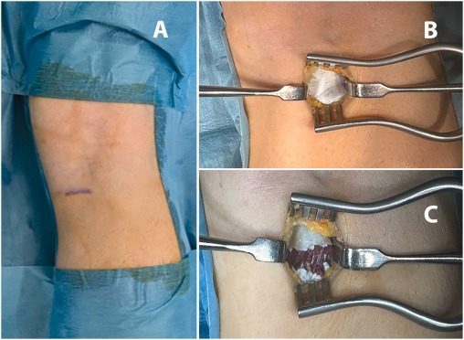 Рис. 13. Проксимальный релиз медиальной головки икроножной мышцы (Strayer / Barouk)