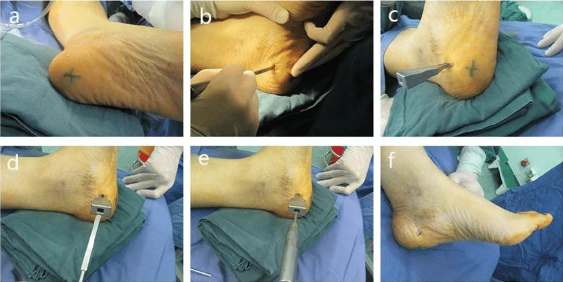 Рис. 12. Миниинвазивный релиз подошвенного апоневроза