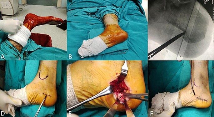 Рис. 11. Открытый релиз подошвенного апоневроза