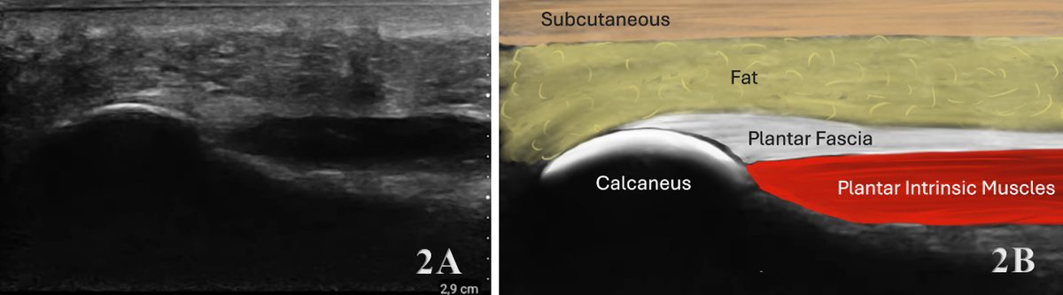 Рис. 6. УЗИ подошвенного апоневроза