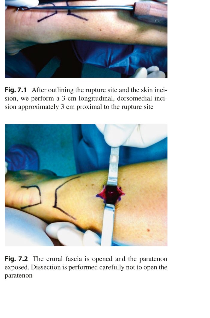 Рис. 1. Миниинвазивная техника PARS-Dresden: (сверху) определение зоны разрыва, разметка разреза - 3 см продольный разрез в 1 см от зоны разрыва; (снизу) фасция голени открыта, паратенон обнажён. Адаптировано из Adams, 2023