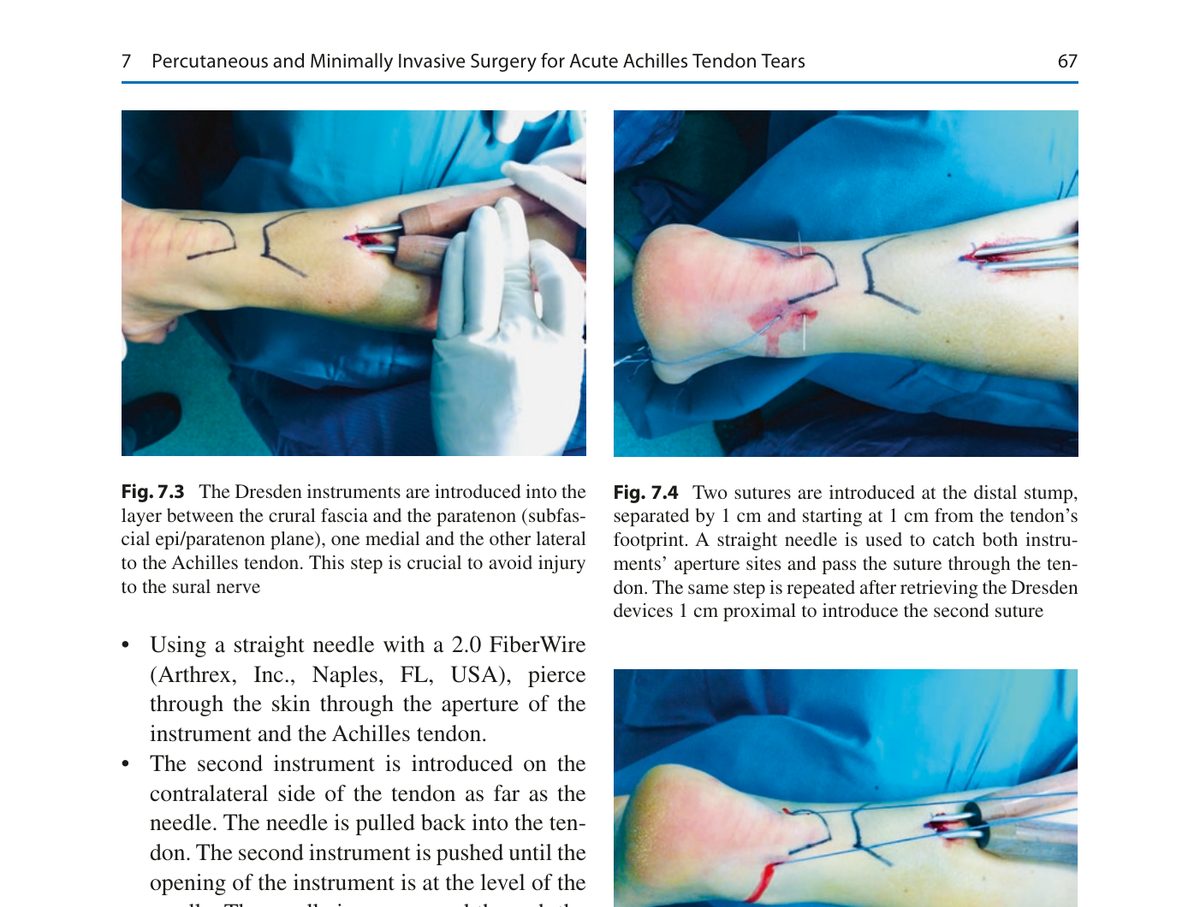 Рис. 2. Техника PARS-Dresden: (a) дрезденские инструменты введены между фасцией голени и паратеноном, медиально и латерально от сухожилия; (b) две нити FiberWire проведены через дистальную культю; (c) инструмент извлечён через проксимальный разрез с аксиальной тракцией. Адаптировано из Adams, 2023