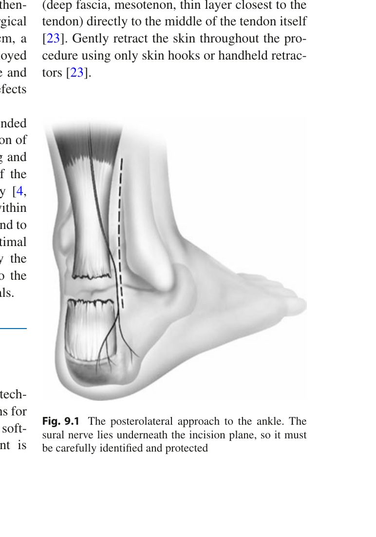 Рис. 3. Открытый доступ к ахиллову сухожилию: продольный заднемедиальный разрез. Адаптировано из Adams, 2023