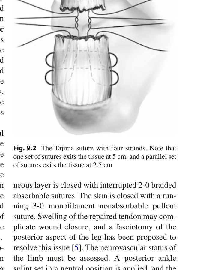 Рис. 4. Шов по Tajima: четырёхниточная модификация для открытого шва ахиллова сухожилия. Адаптировано из Adams, 2023