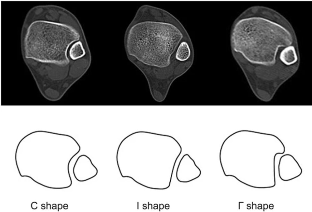 Рис. 2. Варианты строения межберцового синдесмоза