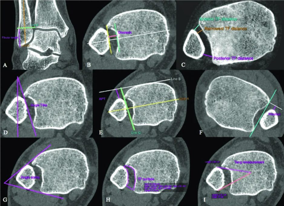Рис. 13. Предложенные в литературе углы и дистанции для оценки синдесмоза