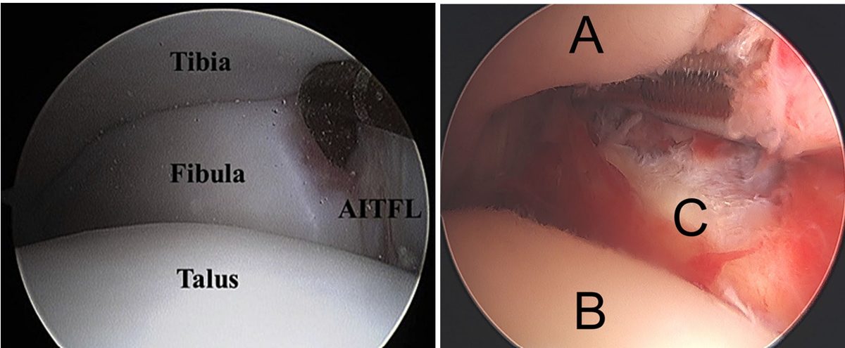 Рис. 17. Артроскопический вид нормального и повреждённого синдесмоза