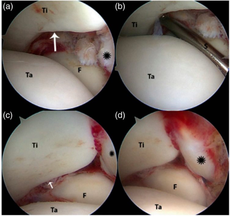 Рис. 18. Артроскопический вид повреждённого синдесмоза: a — внешний вид, b — положительный стресс-тест, c и d — этапы устранения подвывиха