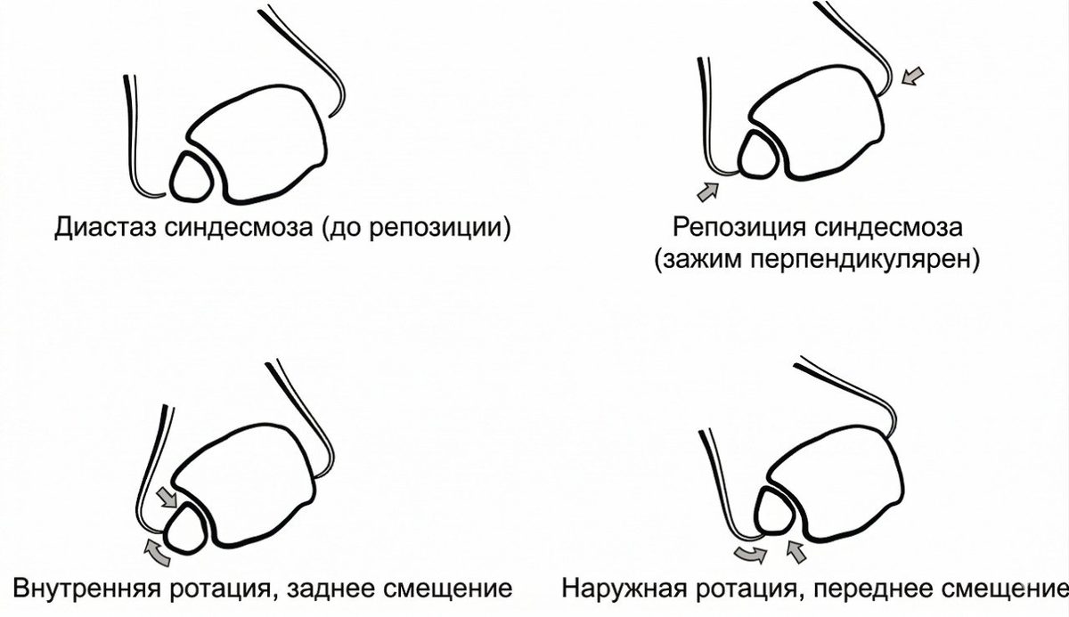 Рис. 20. Влияние положения щипцов на смещение малоберцовой кости при репозиции синдесмоза