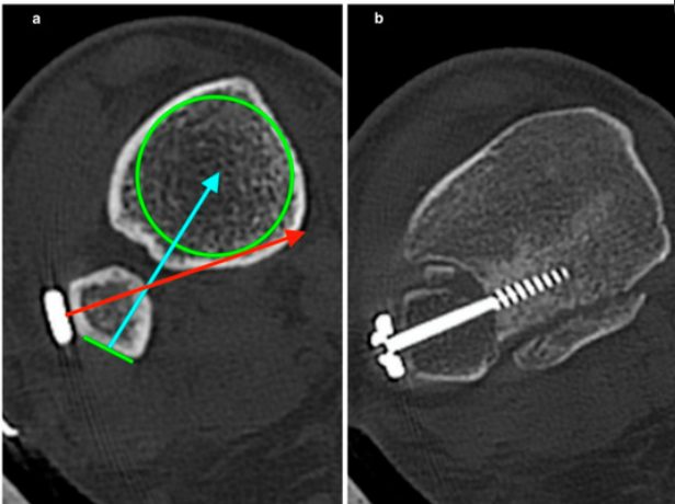 Рис. 24. Ошибки при фиксации межберцового синдесмоза
