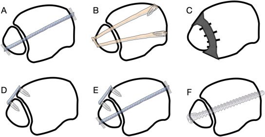 Рис. 21. Варианты фиксации межберцового синдесмоза
