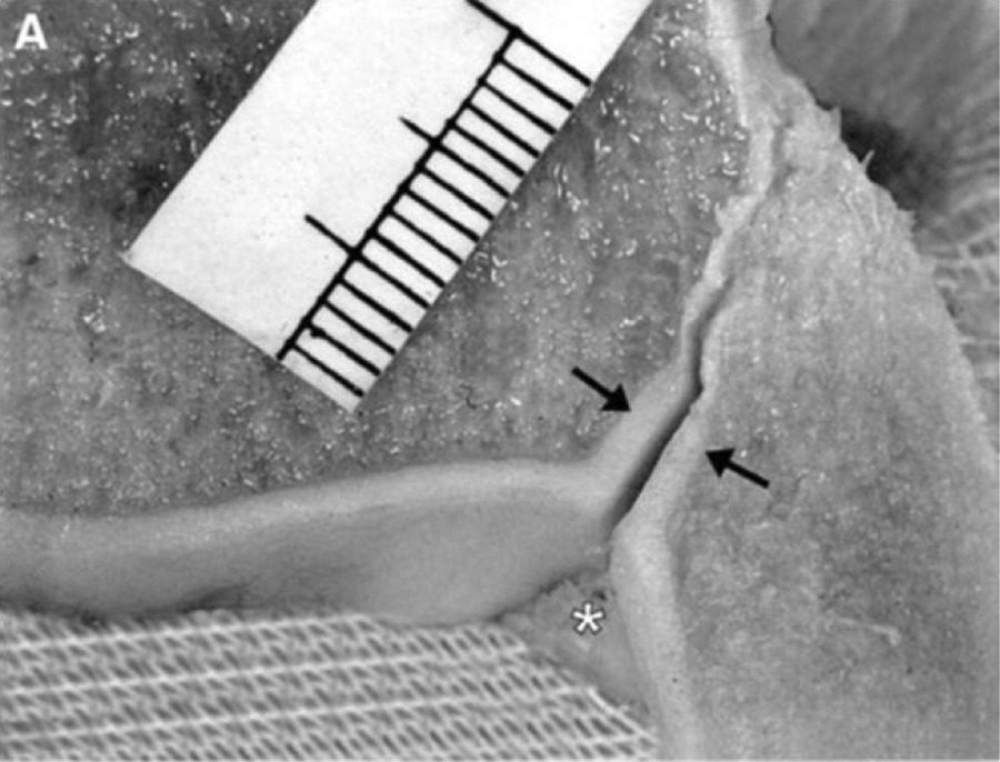 Рис. 3. Суставная поверхность межберцового синдесмоза