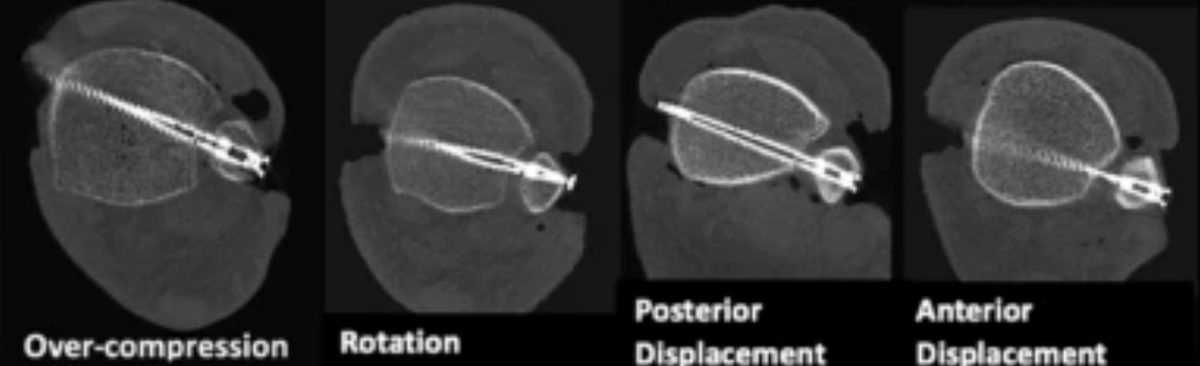Рис. 23. Возможные варианты неправильной фиксации межберцового синдесмоза