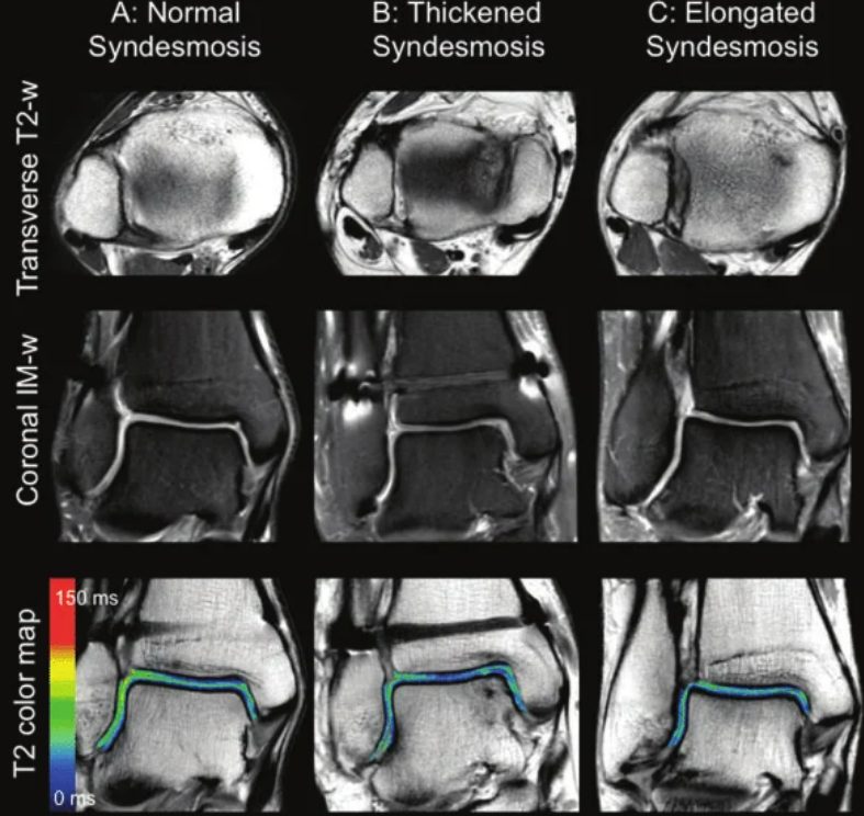 Рис. 16. МРТ-изображение различных состояний синдесмоза: А — нормальное, В — рубцово изменённое, С — элонгированное (удлинённое)