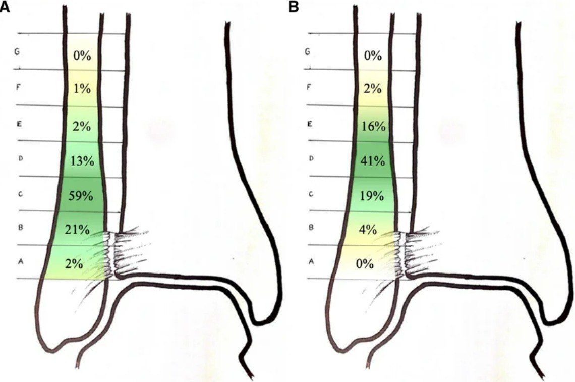 Рис. 22. Зона установки позиционных винтов по результатам опроса хирургов. А — установка первого винта, В — установка второго винта