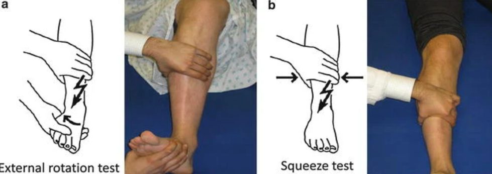 Рис. 12. Стресс-тесты оценки стабильности межберцового синдесмоза