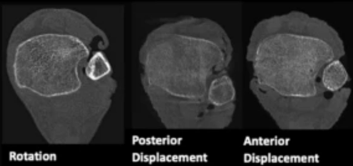 Рис. 19. Возможные варианты подвывиха в межберцовом синдесмозе