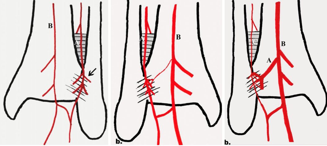 Рис. 10. Варианты расположения сосудов в области межберцового синдесмоза