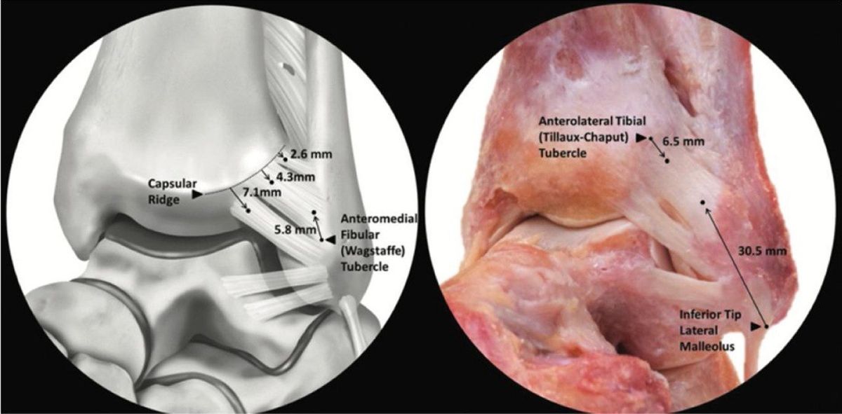 ПНМБС — артроскопические площадки прикрепления