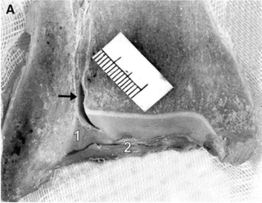 Тибиофибулярная контактная зона — кадаверный препарат