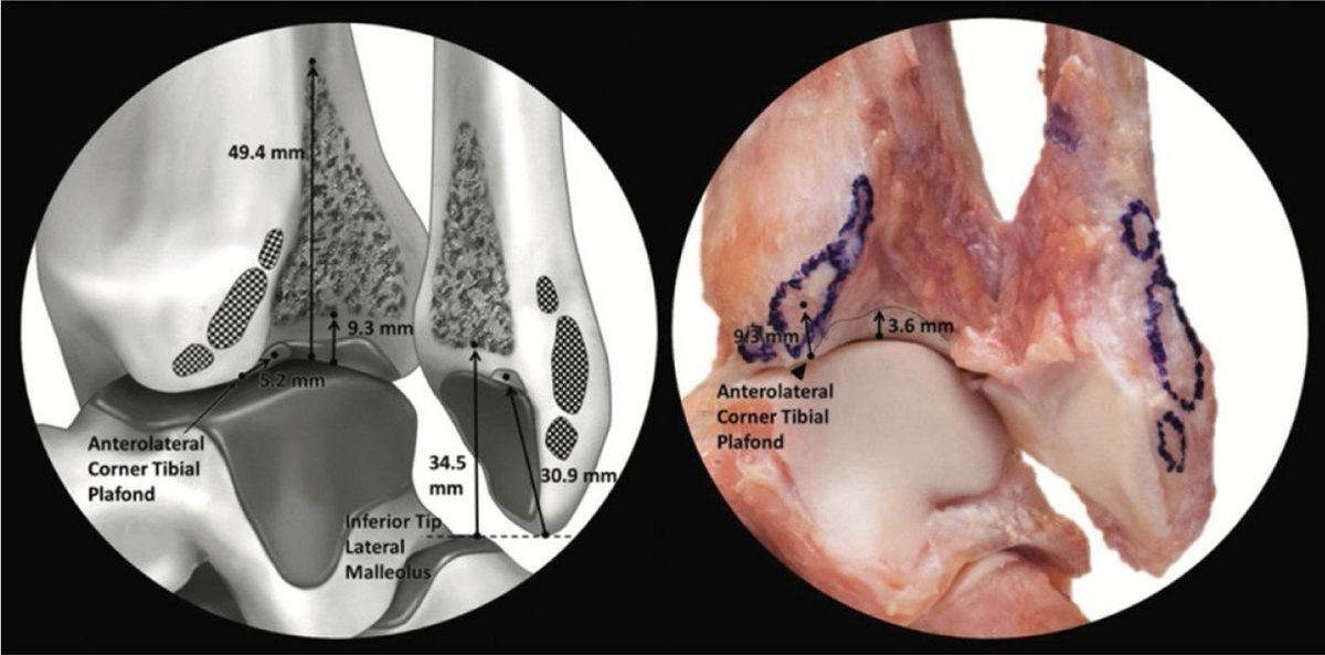Межкостная связка — пирамидальная форма