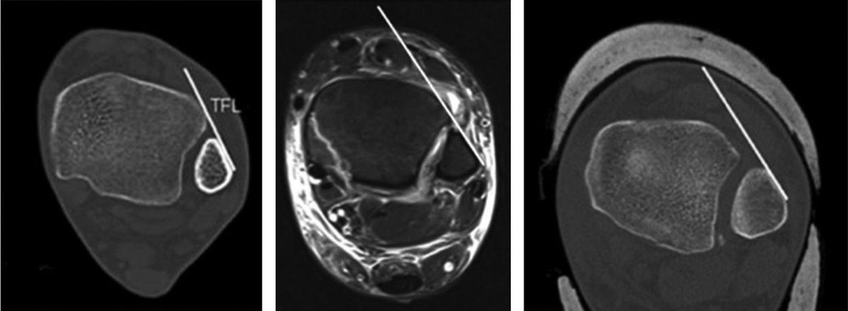 Тибиофибулярная линия Гиффорда — КТ и МРТ