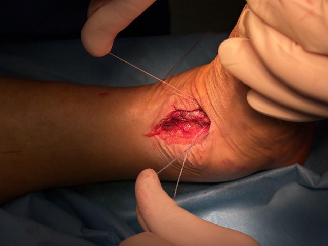 Рефиксация сухожилия передней большеберцовой мышцы (Tibialis Anterior Tendon repair)